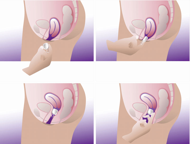 Diagram showing correct placement and removal of a cube pessary