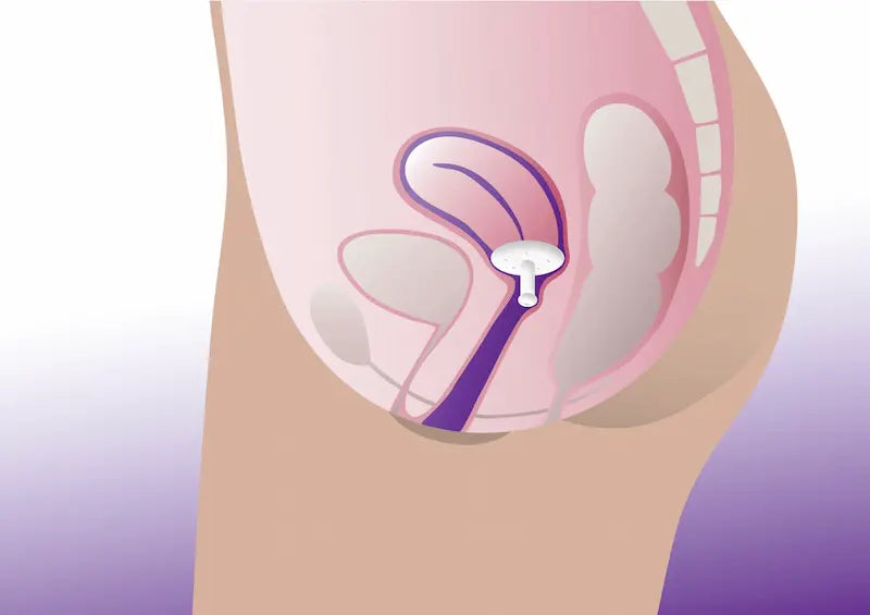 Diagram of Gellhorn long stem pessary used for cystocele and rectocele
