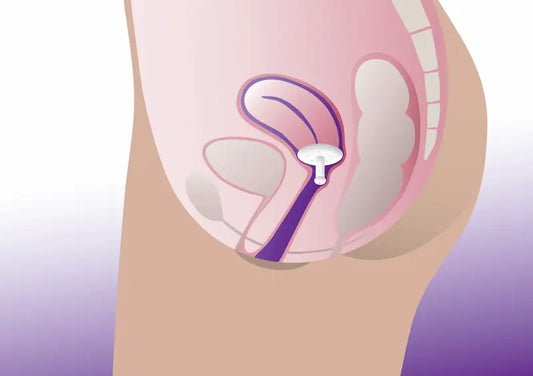 Diagram of Gellhorn pessary short stem for uterine prolapse, cystocele and rectocele