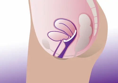 Diagram of inserted ring pessary with knob without support