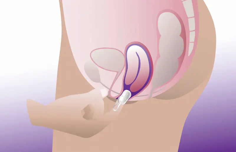 Diagram showing insertion of a cube pessary