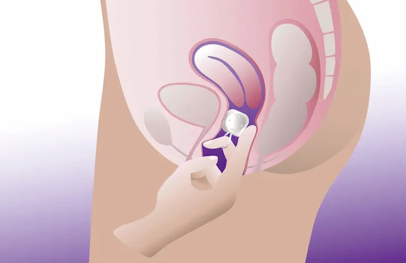 Diagram showing removal of a cube pessary