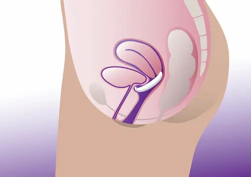 Illustration of a female reproductive system with a focus on the cervix on insert cup pessary diagram