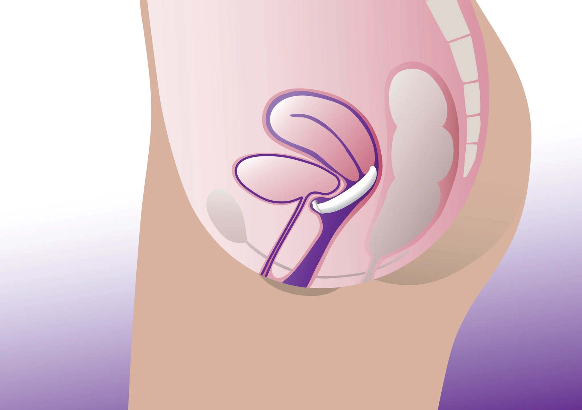 Diagram of dish pessary in position