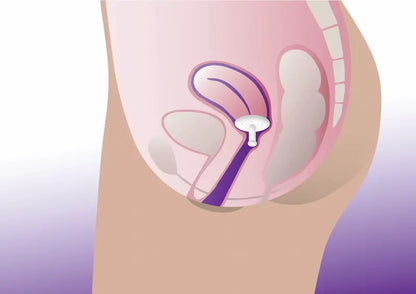 Diagram of Gellhorn long stem pessary used for cystocele and rectocele