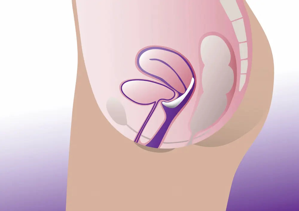 How a Marland Incontience Pessary Works Diagram